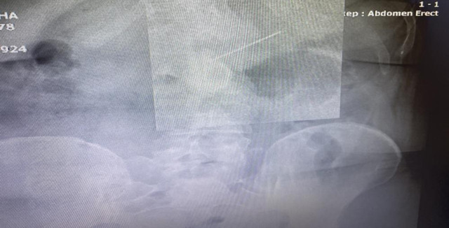 İki çocuk annesi hapşırınca yuttu! Yaklaşık 3,5 santim midesinden çıkarıldı - Resim: 1