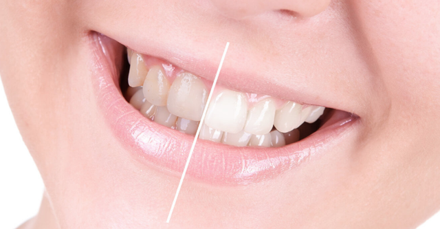 Sararan dişler nasıl beyazlar işte ilk olarak yapmanız gerekenler - Resim: 0