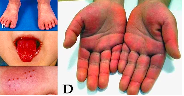 Kawasaki sendromu hastalığı belirtileri neler ateşe dikkat! - Resim: 1