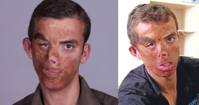 7 yıl geçti! Türkiye'nin ilk yüz nakli olan Uğur Acar'ın son haline bakın - Resim: 1