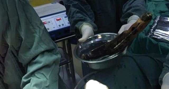 Karın ağrısıyla hastaneye koştu içinden devasa bir patlıcan çıktı - Resim: 2