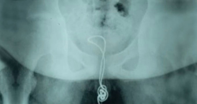 Cinsel organına USB kablosu sıkıştı! Bu kadarına pes - Resim: 1