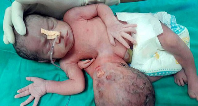 Yenidoğan bebeğin karnından çıkan doktorları şoke etti! - Resim: 1