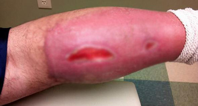 Bacağında tenis topu büyüklüğünde delik açıldı doktora gidince acı gerçeği öğrendi! - Resim: 1