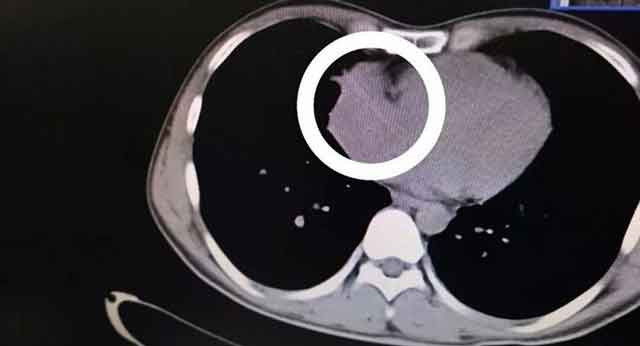 Yuttuğu kürdan kalbinden çıktı tıp dünyası şoka girdi!  - Resim: 2
