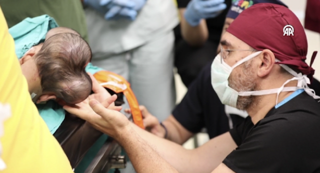 Başkan Erdoğan talimat vermişti! Türkiye'ye getirilen Pakistanlı yapışık ikizler 14 saatlik operasyonla ayrıldı - Resim: 8