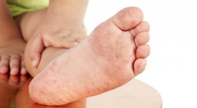 Ayakta kırmızı lekeler neden olur hastalık habercisi midir? - Resim: 2