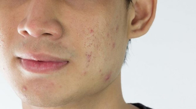 Sivilce lekeleri nasıl geçer sivilce lekelerinden kurtulmak için altın değerinde tüyolar! - Resim: 0