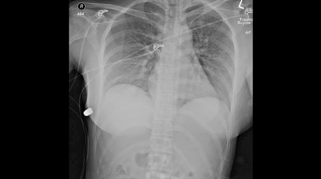 Silahla vurulan kadını göğsüne taktırdığı silikonlar kurtardı! Şaka değil gerçek! - Resim: 0