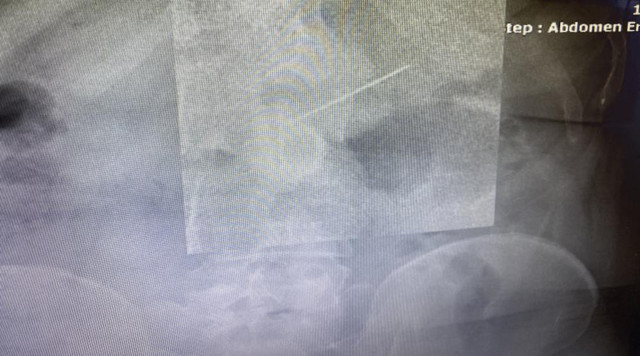 İki çocuk annesi hapşırınca yuttu! Yaklaşık 3,5 santim midesinden çıkarıldı - Resim: 0