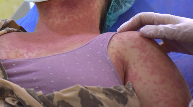 Van'da 4 kişi internet ve aktardan aynı kremi aldı hayatları karardı - Resim: 1