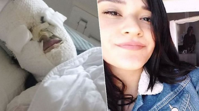Hatay'da yüzü yakılan  Berfin Özek'ten kötü haber! Gözünü kaybedebilir - Resim: 1