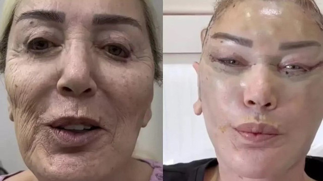 Seda Sayan'dan sonra ablası Nursel Sayan estetik için bıçak altına yattı - Resim: 1