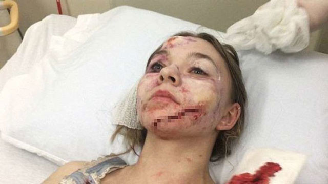 Korkunç kaza! Taylor Hickson'ın yüzüne 70 dikiş atıldı - Resim: 3