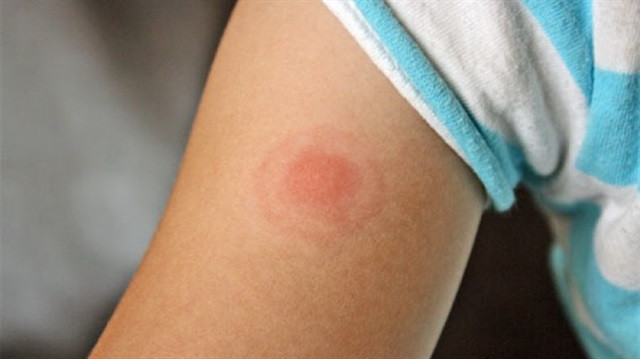 Bu virüs 365 hastalığı taklit edebiliyor! - Resim: 1