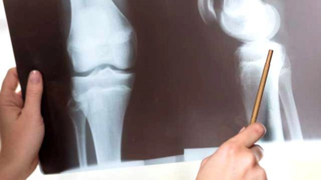 Kayısının faydaları neler? Kayısı tüketmek için 7 önemli neden! - Resim: 4