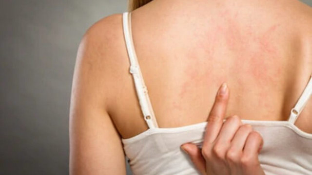 Prof. Dr. Nilgün Atakan: Her 4 kişiden birinde ürtiker hastalığı görülüyor - Resim: 2