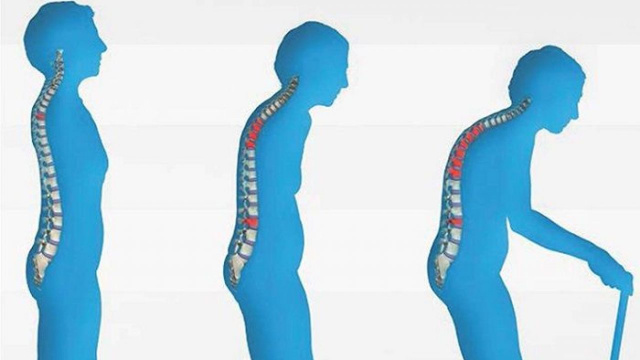 Türkiye'de 50 yaş üzerindeki 4 kişiden birinde osteoporoz bulunuyor - Resim: 1