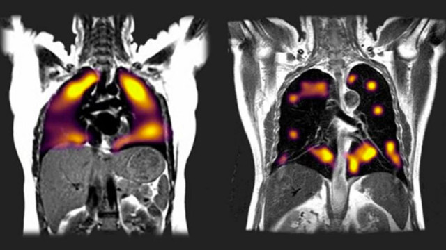 Yeni tarama yöntemiyle bulundu iyileşen Kovid-19 hastalarında 3 ay sonra ortaya çıkıyor - Resim: 0