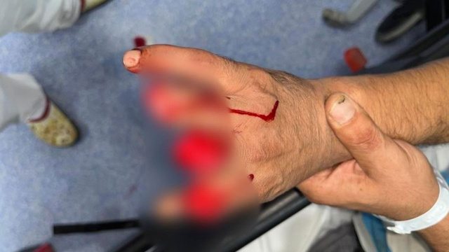 3 parmağını kaybetti ben bittim derken 12 saat sonra parmaklarını buldu - Resim: 0