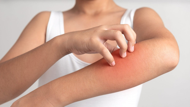 Şiddetli kaşıntınız varsa ve bir türlü geçmiyorsa uyuz olabilirsiniz! İşte belirtileri - Resim: 0