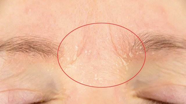 Bu aylarda cildim pul pul dökülüyor diyenler bunları yaşıyorsanız dikkat! - Resim: 1