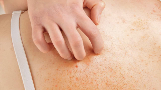 3 hafta sonra ortaya çıkıyor kaşıntıyla başlıyor! Aman dikkat kuduz olabilirsiniz - Resim: 2