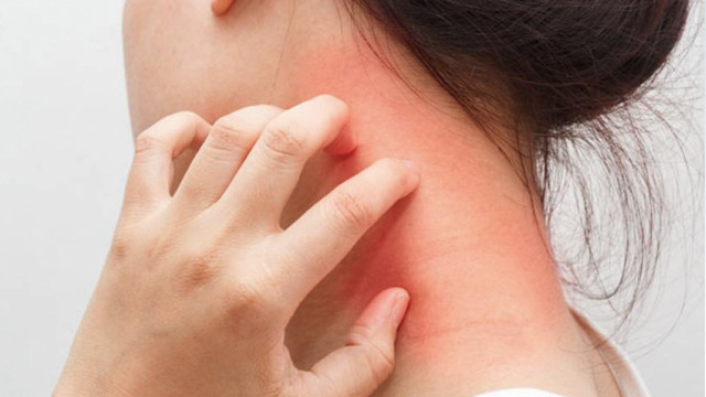 3 hafta sonra ortaya çıkıyor kaşıntıyla başlıyor! Aman dikkat kuduz olabilirsiniz - Resim: 0