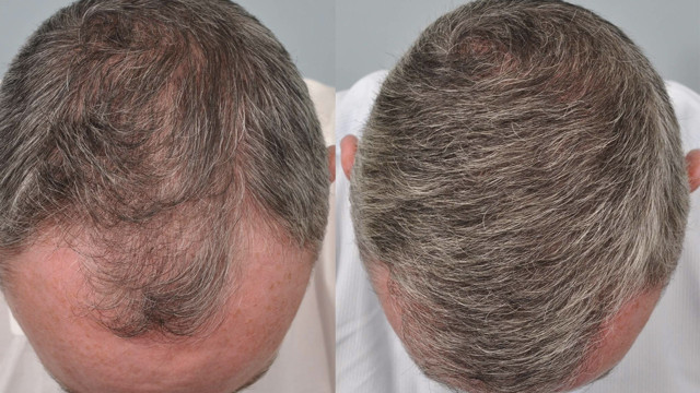 Sürün saçınız fışkırsın İşte saç dökülmesine meydan okuyan kür tarifi - Resim: 0