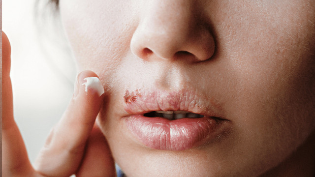 Dudağınızda çıkan uçuğu yok edecek doğal karışım! Günde 4 kez sürün sonucu görün - Resim: 0