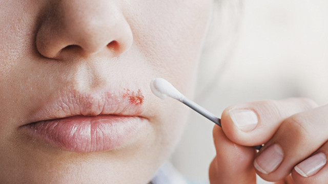 Dudağınızda çıkan uçuğu yok edecek doğal karışım! Günde 4 kez sürün sonucu görün - Resim: 2