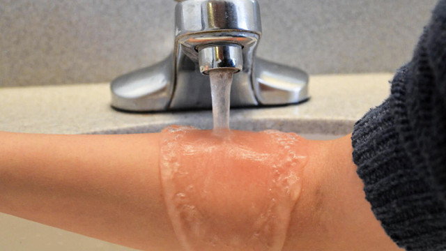 Diş macunu, et, yoğurt bunları unutun! İşte yanıklarda ilk yapılacak tedavi şekli - Resim: 0