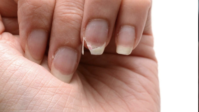 Tırnak bozulmasının nedenleri sakın hafife almayın! Ciddi hasta olabilirsiniz - Resim: 0
