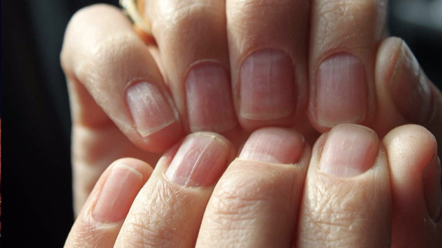 Tırnak bozulmasının nedenleri sakın hafife almayın! Ciddi hasta olabilirsiniz - Resim: 1