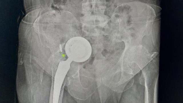 Doktorları dinlemedi, vücudunda gezmeye başladı! Karnından ve ayağından çıkarıldı - Resim: 2