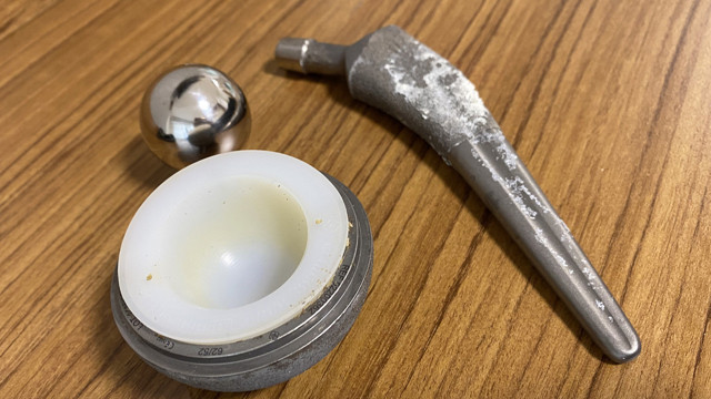 Doktorları dinlemedi, vücudunda gezmeye başladı! Karnından ve ayağından çıkarıldı - Resim: 0