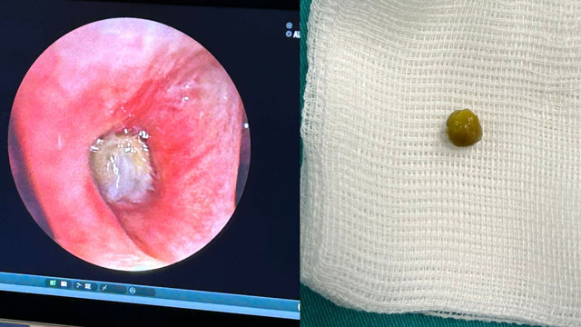 Yakınması ne yapsa geçmedi, doktorlar akciğerine bakarken şok oldu: Yetişkinlerde görülebilir - Resim: 0