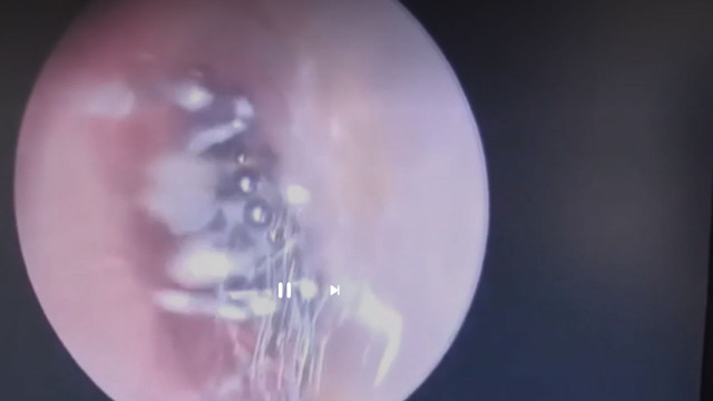 Tüyler ürperten olay: "Çınlama var" diye doktora gitti kulağına yuva yapmış! - Resim: 1