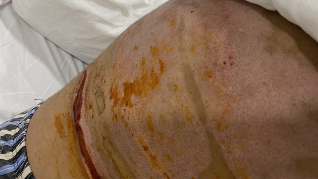 Barda dehşeti yaşayan genç kız içler acısı halde! "Sıcak su kaynatırken bile korkuyorum" - Resim: 0