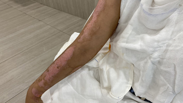 Barda dehşeti yaşayan genç kız içler acısı halde! "Sıcak su kaynatırken bile korkuyorum" - Resim: 1