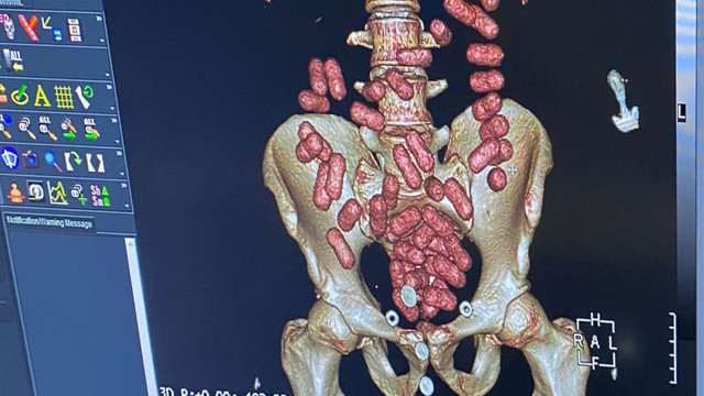 İstanbul Havalimanı'nda yolcunun midesinden 640 gram kokain çıktı - Resim: 0