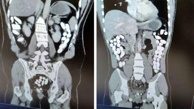 Erzincan'da yabancı uyruklu uyuşturucu kuryelerin midesinden 2 kilo uyuşturucu çıktı - Resim: 0
