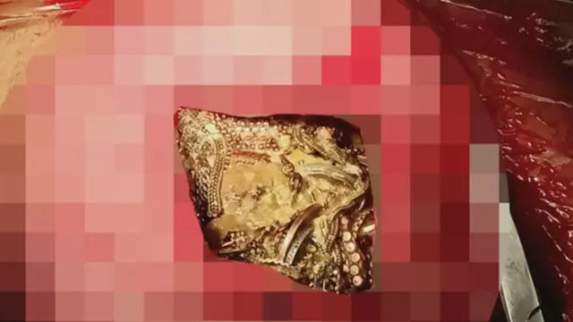 Genç kadının midesi kuyumcu dükkanı gibi! Doktorlar bile şaşkına döndü - Resim: 0