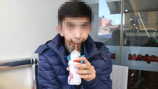 Doğuştan alt çenesi olmayan çocuğa başarılı operasyon: 17 yıl sonra normal yemek yiyebilecek - Resim: 0
