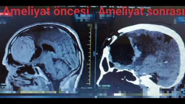 Baş ağrısı şikayetiyle gitti, beyninde 8 santimlik kitle çıktı - Resim: 0
