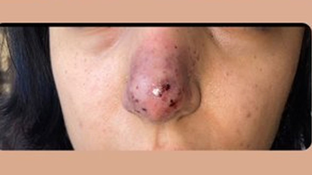 İzmir'de güzellik merkezinde yaşandı: Dolgu yaptırdı, burnunu kaybetti! - Resim: 2