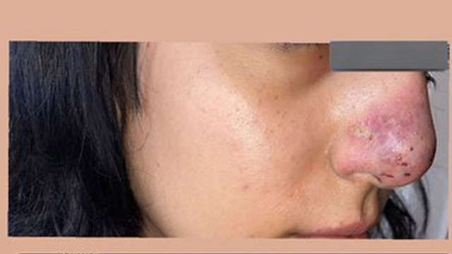 İzmir'de güzellik merkezinde yaşandı: Dolgu yaptırdı, burnunu kaybetti! - Resim: 0