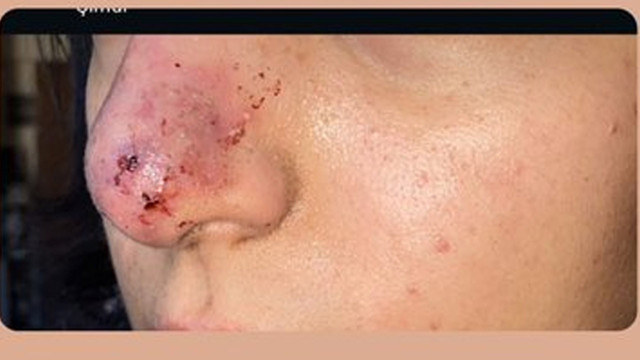 İzmir'de güzellik merkezinde yaşandı: Dolgu yaptırdı, burnunu kaybetti! - Resim: 1