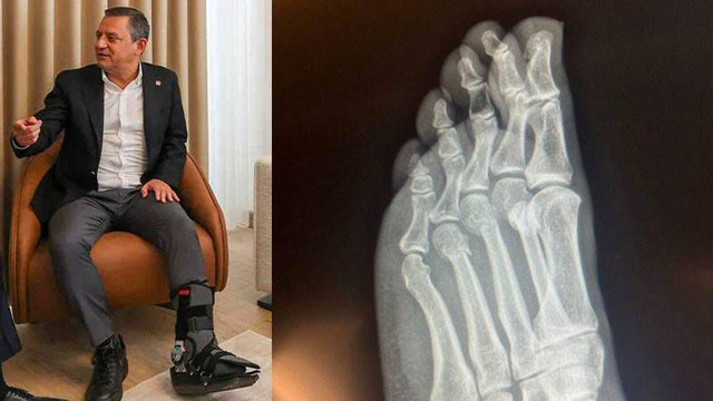 Özgür Özel kırılan ayağının röntgen filmini paylaştı - Resim: 0