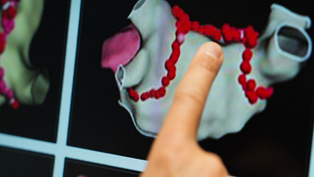 Kalp ritmi bozukluklarında sihirli dokunuş! Ablasyon tedavisiyle kalıcı çözüm! - Resim: 1